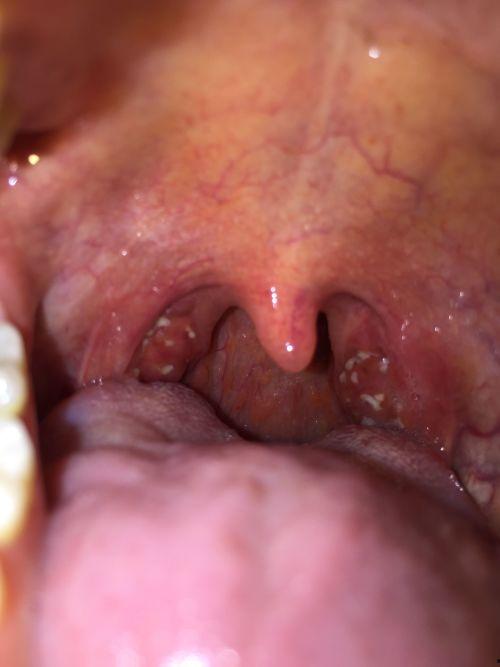 夏天吃瓜喉咙沙哑了